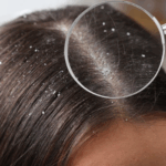 dandruff treatment