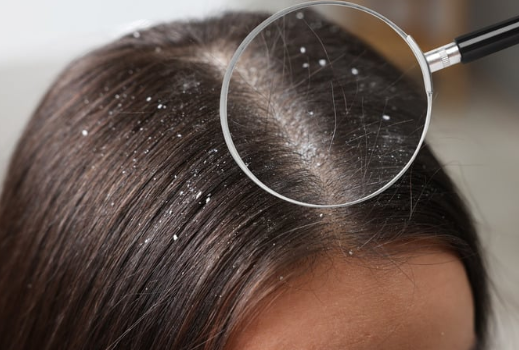 dandruff treatment